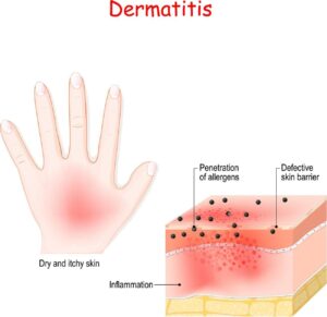 Dermatitis Symptoms